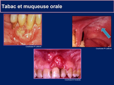 Facteurs de risque des maladies parodontales