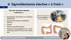 Fondamentaux chirurgie digestive - Diverticulose