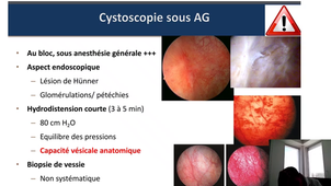 Item 41 Syndrome Douloureux Vésical Chronique