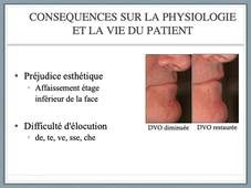 UE 44 EC2 Odontologie : Conséquence perte des dents