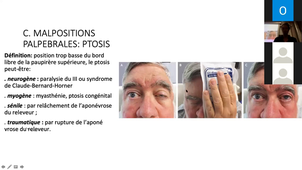 DFASM2 - Ophtalmologie - Paupières
