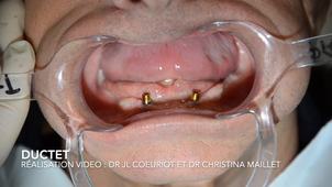 PAC 3A : Déglutition : remontee du plancher buccal
