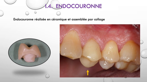 UE44 EC2 Odontologie : Expressions cliniques de la prothèse Partie 1