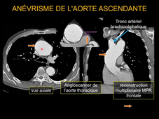 MEDLIB 701-901 MEDIASTIN PLEVRE 1ère PARTIE
