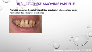 UE44 EC2 Odontologie : Expressions cliniques de la prothèse Partie 2