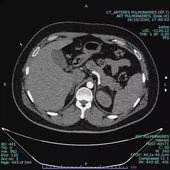 Embolie pulmonaire scanner
