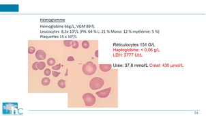 DFGSM2 - MEDLIB0403 - Physiopathogénie du purpura thrombotique thrombocytopénique - PPT héréditaire et acquis