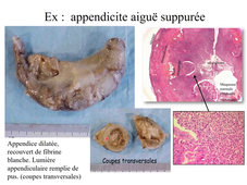 DFGSM3 - MED0602 - Pathologie inflammatoire - Inflammation aiguÃ«