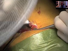 DPC-Video TIPP gillion