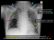MEDLIB 701-901 MEDIASTIN PLEVRE 3ème PARTIE