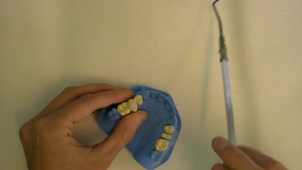 Dépose-couronne : Utilisation