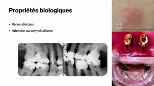Chapitre 1 Partie 3 : Alliages dentaires