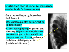 depistage scoliose et cyphose (item A)