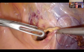 DPC-TAPP-Video