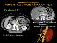 MEDLIB 701-901 RADIO-ANATOMIE VEINEUSE TVP  EMBOLIE PULMONAIRE 1ère PARTIE