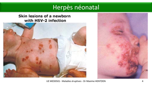 DFGSM3 - MED0501 - Maladies éruptives virales - Herpès néonatal