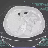 Embolie pulmonaire 2 scanner