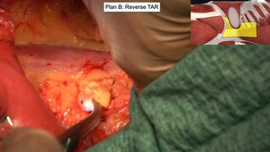 session 4 cours 11 denervation-miguel