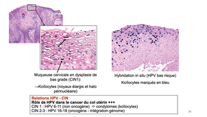 DFGSM3 - Semestre 2 - MED0602 - Pathologie tumorale - Dysplasie, Néoplasie intra-épithéliale, Etat pré-cancéreux