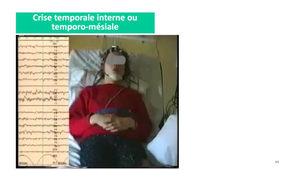 DFGSM2 - MED0308 - Sémiologie neurologique - Malaise, perte de connaissance résolutive / Convulsions / Episode neurologique paroxystique