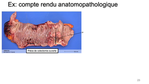 DFGSM3 - Semestre 2 - MED0602 - Pathologie tumorale - Généralités sur les tumeurs (rappels)