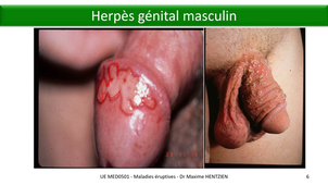 DFGSM3 - MED0501 - Maladies éruptives virales - Herpès génital - HSV-2