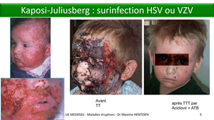 DFGSM3 - MED0501 - Maladies éruptives virales - HSV-1 :  Primo-infection