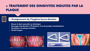 UE44 EC2 Odontologie : Gingivite