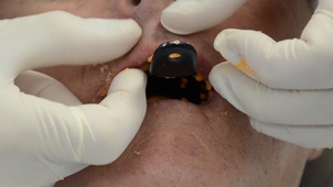 Empreinte d'étude maxillaire alginate