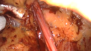 DPC-TEP-VIDEO-obliq-ext