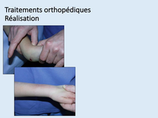 fractures chez l'enfant (item A)