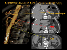 MEDLIB 701-901 Radio-anatomie Aorte Membres inférieurs Artères digestives
