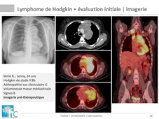 DFGSM2 / DFGSMa2 - MED0304 - Adénopathies et Splénomégalie - Imagerie