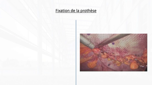 Session 3 cours 10 ipom coelio