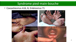 DFGSM3 - MED0501 - Maladies éruptives virales - Les entérovirus