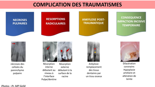 UE 44 EC2 Odontologie : Traumatismes dentaires
