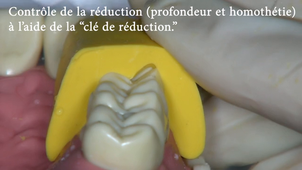 PCP 25 reduction OV