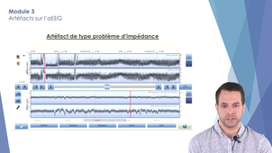 Module 3 - Artéfacts sur l'aEEG