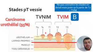 Item 314  Tumeurs vésicales