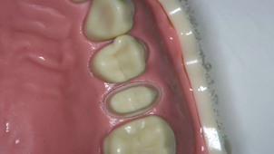 PCP 25 finitions