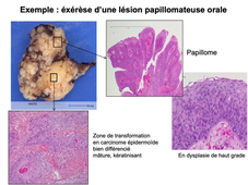 DFGSM3 - Semestre 2 - MED0602 - Pathologie tumorale - Principaux types de tumeurs malignes