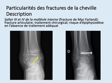 particularites des fractures du coude et de la cheville (item C)