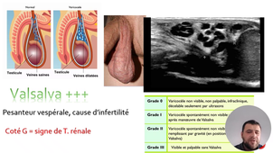 ITEM 50 FASCITE NECROSANTE DES OGE