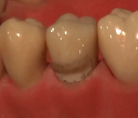 SiSta 3.3 sur 35 (V)