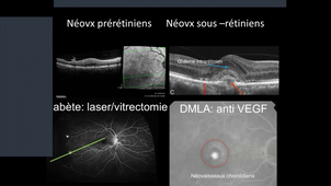 DFASM2 - Ophtalmologie - Cataracte / DMLA