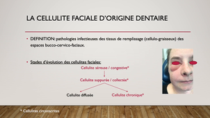 UE44 EC2 Odontologie : Infection en chirurgie orale