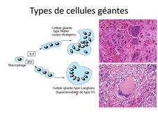DFGSM3 - MED0602 - Pathologie inflammatoire - Inflammations granulomateuses : généralités