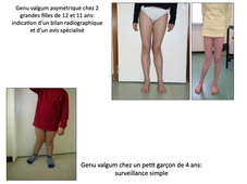 depistage des anomalies des axes des membres inferieurs (item B)