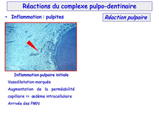 PASS / L.AS - UE 21 - EC 5 - Le complexe pulpo-dentinaire : hypersensibilité dentinaire, carie dentinaire