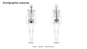 DFGSM2 - MED0308 - Sémiologie radiologique - Scintigraphie osseuse